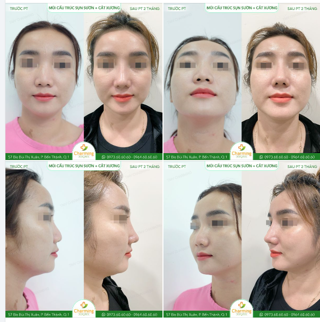 Sau khi thực hiện phẫu thuật nâng mũi cấu trúc sụn sườn kết hợp với cắt xương, diện mạo của nàng khách đã có sự thay đổi đáng kinh ngạc.