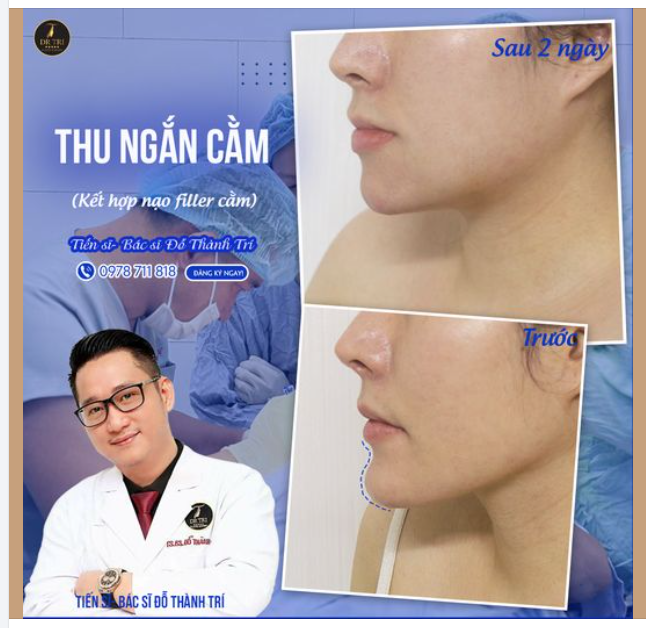 KẾT QUẢ SAU 2 NGÀY PHẪU THUẬT THU NGẮN CẰM VÀ NẠO FILLER CŨ: