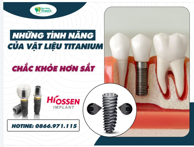 TẠI SAO TITANIUM LẠI ĐƯỢC DÙNG TRONG NHA KHOA - CHẮC KHỎE HƠN SẮT