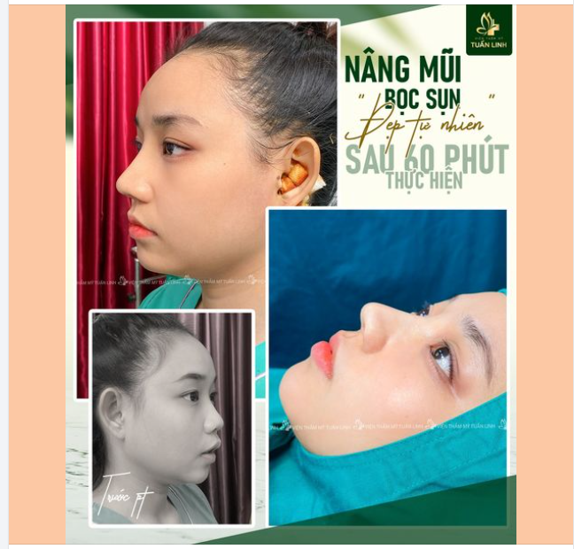 Nâng mũi Sline bọc sụn tai - Mũi đẹp tự nhiên sau 60 phút!!