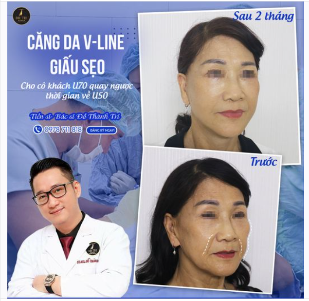 Phải thốt lên "đỉnh nóc" với ca căng da này mọi người ạ! Cô khách U70 trẻ đẹp thấy rõ!
