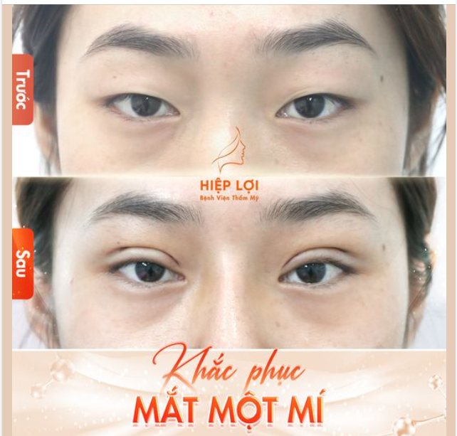 Hình ảnh thực tế sau 2 tuần "cắt mí" của khách nhà Hiệp Lợi