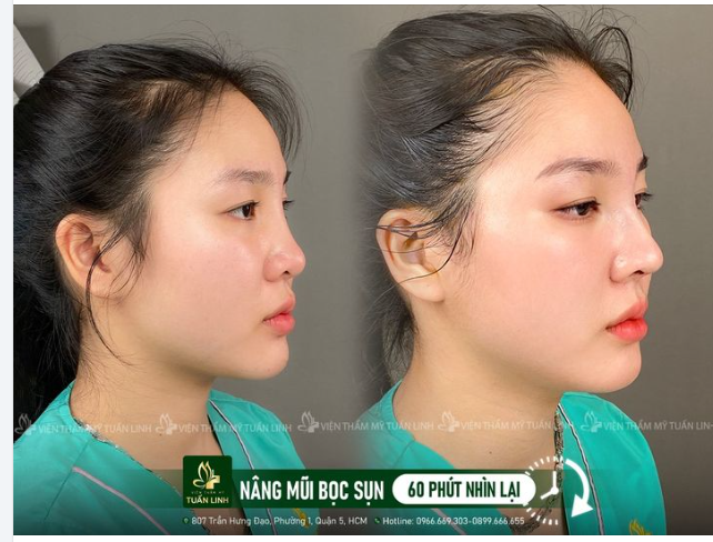 Nâng mũi Sline bọc sụn tai -> Mũi Đẹp tự nhiên, không đơ cứng, hài hòa, cân đối và sắc nét.