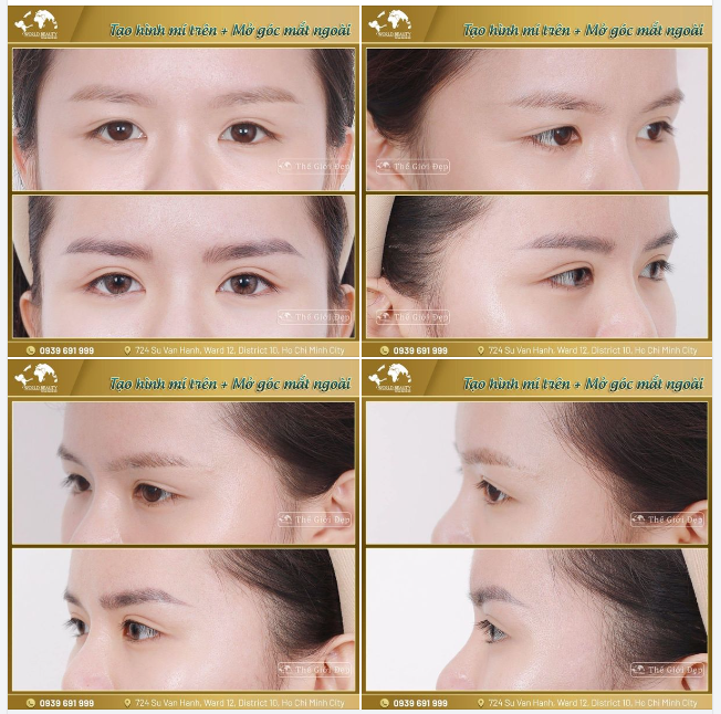 Đôi mắt với nếp mí nhỏ, ti hí, góc mắt hẹp thường là nhược điểm khiến gương mặt u buồn và thiếu sức sống.