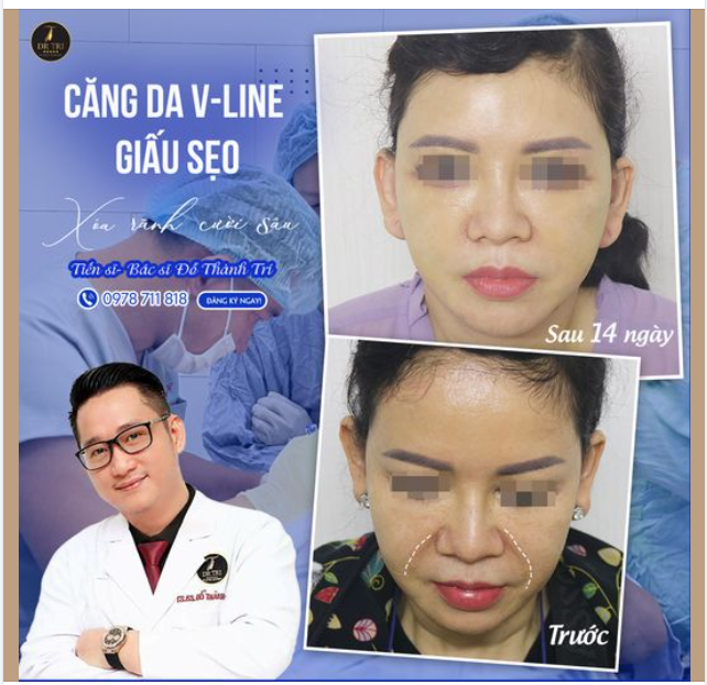 Trẻ Hóa Gương Mặt Chỉ Sau 14 Ngày!