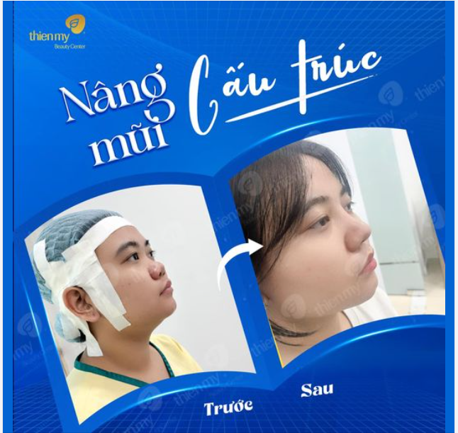 Feedback Những hình ảnh chân thực của khách hàng sau khi nâng mũi tại PKCK Thiện Mỹ giúp khách hàng thăng hạng nhan sắc.