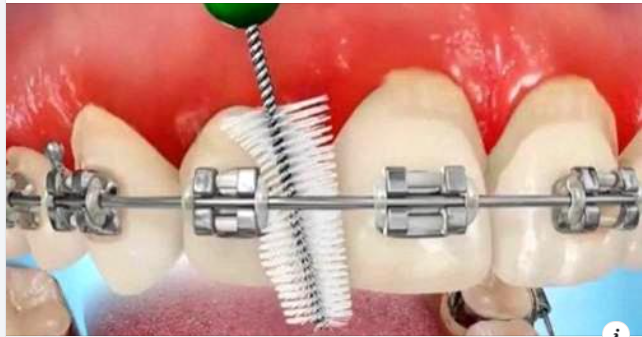 Tại sao nên dùng bàn chải kẽ răng cho răng niềng?