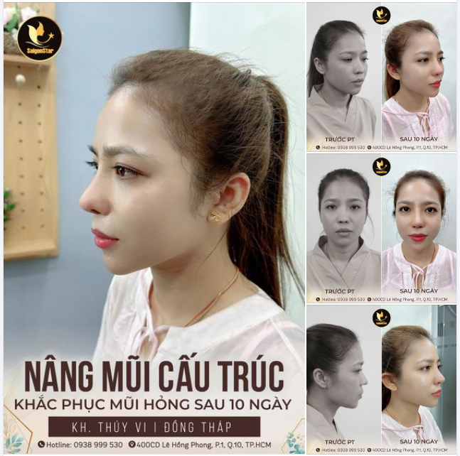 NÂNG MŨI CẤU TRÚC - KHẮC PHỤC MŨI HỎNG CHỈ SAU 10 NGÀY