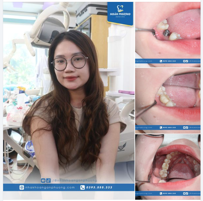 Hoàn thiện phục hình R46 cho cô bạn Thảo Vy