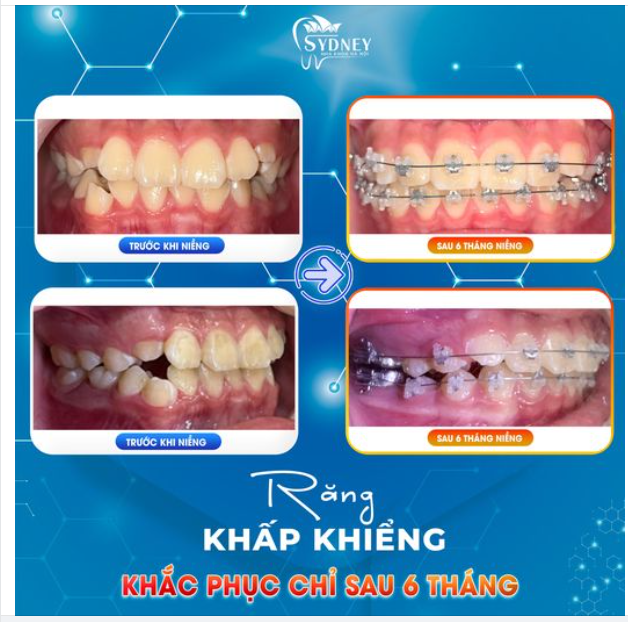RĂNG KHẤP KHỂNH - KHẮC PHỤC CHỈ SAU 6 THÁNG