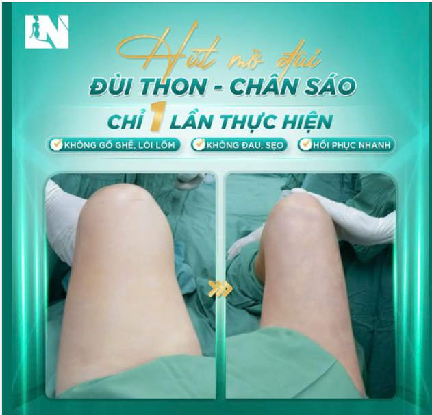 HÚT MỠ ĐÙI thon gọn săn chắc không lòi lõm