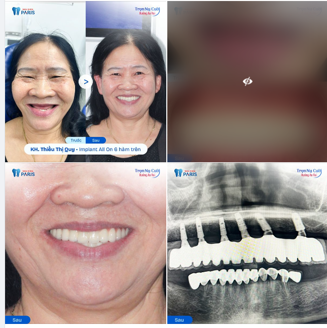 HIỆN THỰC HÓA ƯỚC MƠ - ĂN NHAI THOẢI MÁI VUI HƯỞNG TUỔI GIÀ