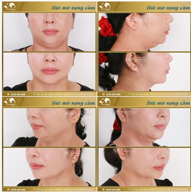 Nọng cằm là tình trạng vùng dưới cằm xuất hiện phần da chùng và mỡ thừa tích tụ, tạo cảm giác như có 2 chiếc cằm.