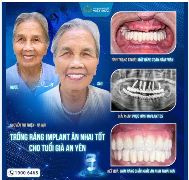 IMPLANT LẤY LẠI SỨC KHỎE VÀ NỤ CƯỜI TỰ TIN