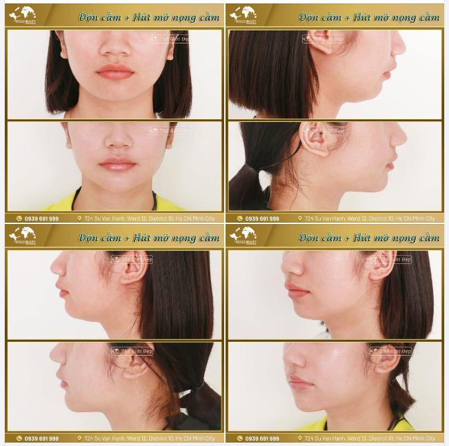 Mong muốn sở hữu một vẻ đẹp toàn diện, kết quả như ý chính là lý do khiến cho Khách hàng chọn combo phẫu thuật khi tìm đến Thế Giới Đẹp.