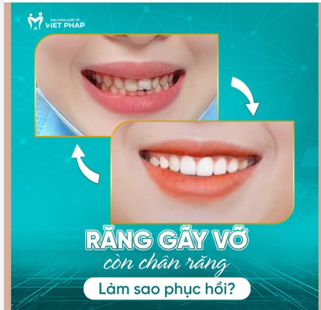 RĂNG BỊ VỠ, GÃY CHỈ CÒN CHÂN RĂNG - LÀM SAO PHỤC HỒI?