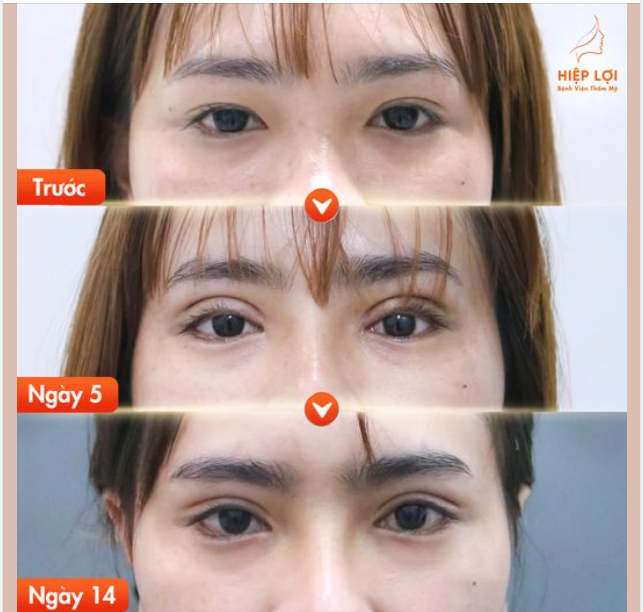 Hình ảnh chân thực sau 14 ngày của khách hàng thực hiện tại BVTM Hiệp Lợi