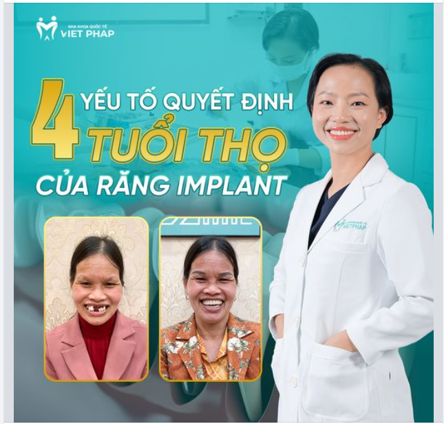 4 YẾU TỐ QUYẾT ĐỊNH TUỔI THỌ CỦA RĂNG IMPLANT