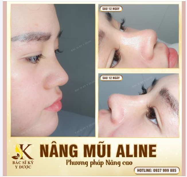 Xuất hiện ở đâu là tâm điểm ở đó bởi Dáng Mũi ALINE cao sang, thanh thoát!