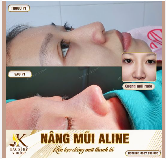 Nâng Mũi ALINE - Dáng mũi đẹp chuẩn từ mọi góc nhìn