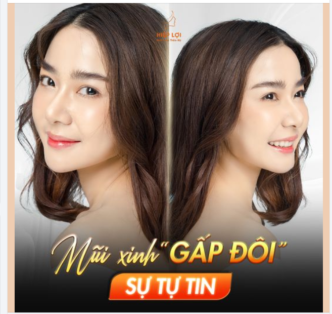 Bạn muốn sở hữu sống mũi cao thanh thoát, giúp khuôn mặt đẹp hoàn hảo?