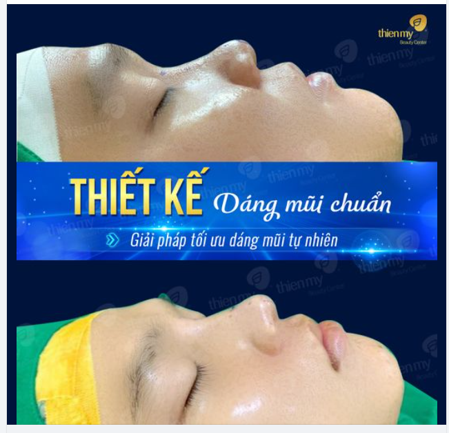 Chọn đúng phương pháp, chất liệu, tay nghề bác sĩ là bí quyết vàng giúp bạn sở hữu dáng mũi đẹp tự nhiên và bền vững theo thời gian.