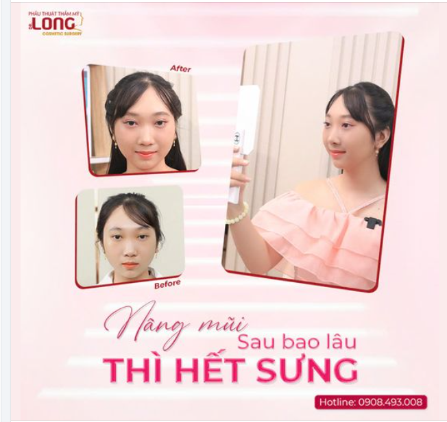 NÂNG MŨI SAU BAO LÂU HẾT SƯNG?
