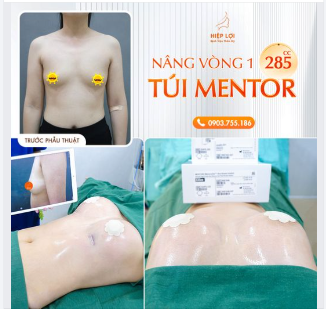 Hình ảnh thực tế sau nâng ngực túi MENTOR 285CC