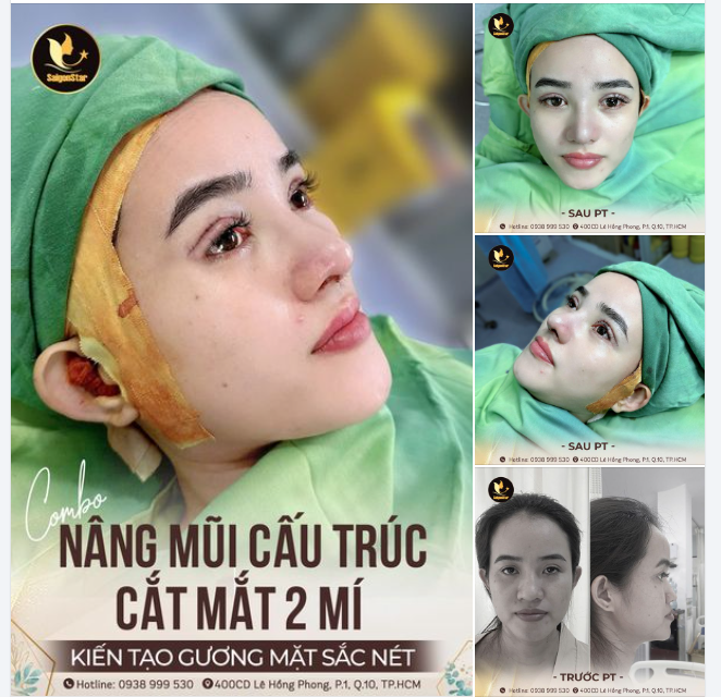 KIẾN TẠO TOÀN DIỆN CÙNG COMBO NÂNG MŨI CẤU TRÚC + CẮT MẮT 2 MÍ