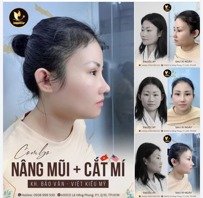 Mũi cao thanh tú, góc nghiêng thần thánh. Mắt 2 mí rõ nét, cân đối, tự nhiên