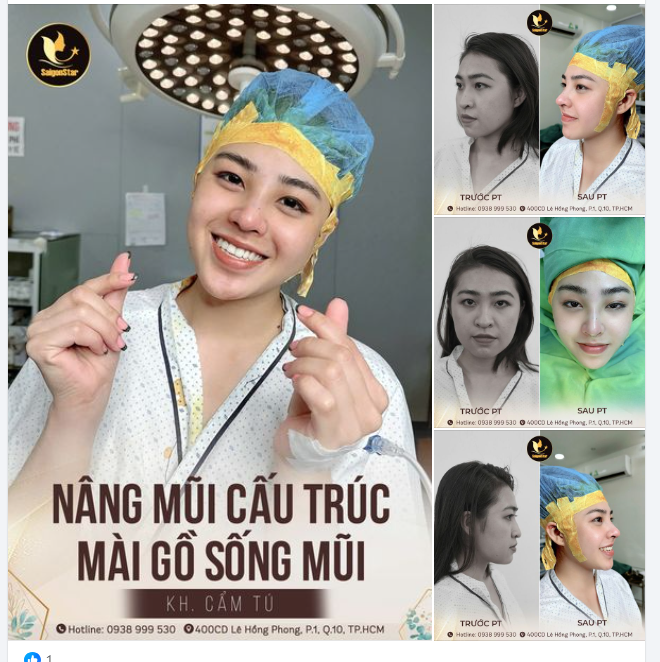 NÂNG MŨI CẤU TRÚC + MÀI GỒ 60 PHÚT THAY ĐỔI 360˚