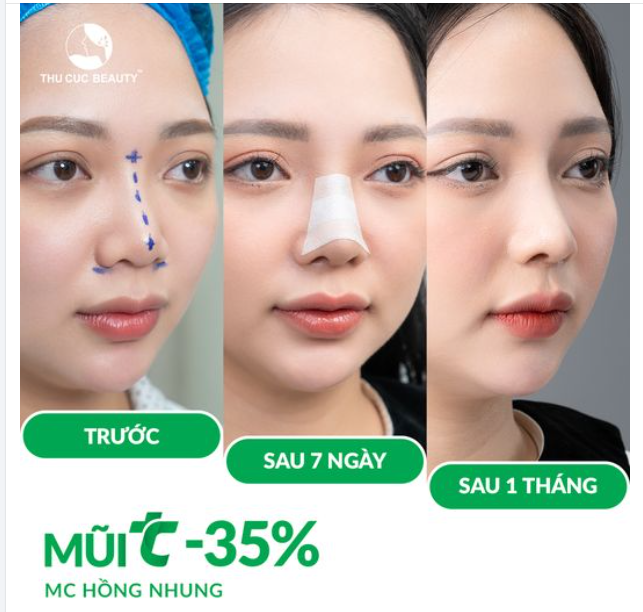 Rinh ngay mũi xinh cùng ưu đãi chỉ còn 10 suất nhanh tay đến ngay TC