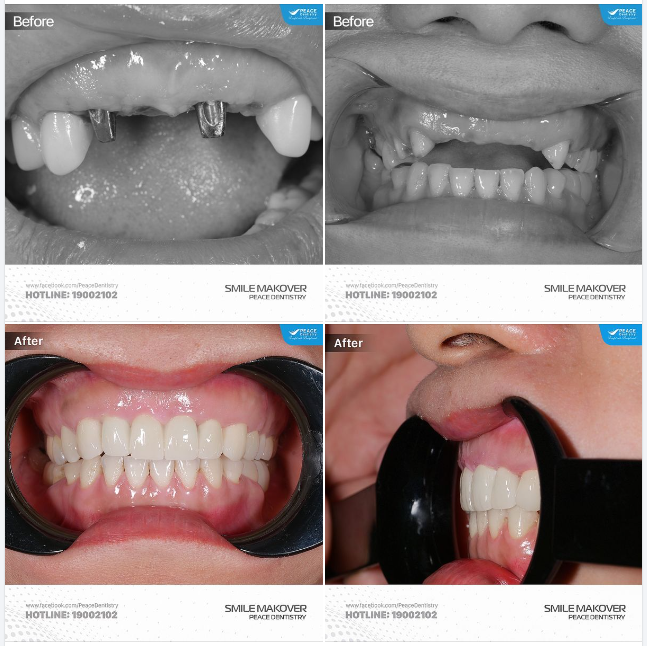 TRỒNG RĂNG IMPLANT: NHIỀU CHƯA CHẮC ĐÃ TỐT !