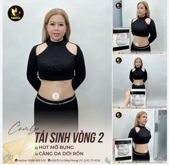 COMBO HÚT MỠ VASER LIPO + CĂNG DA DỜI RỐN THÀNH CÔNG TÁI SINH BODY CHO MẸ BỈM SỮA ĐẾN TỪ SINGAPORE