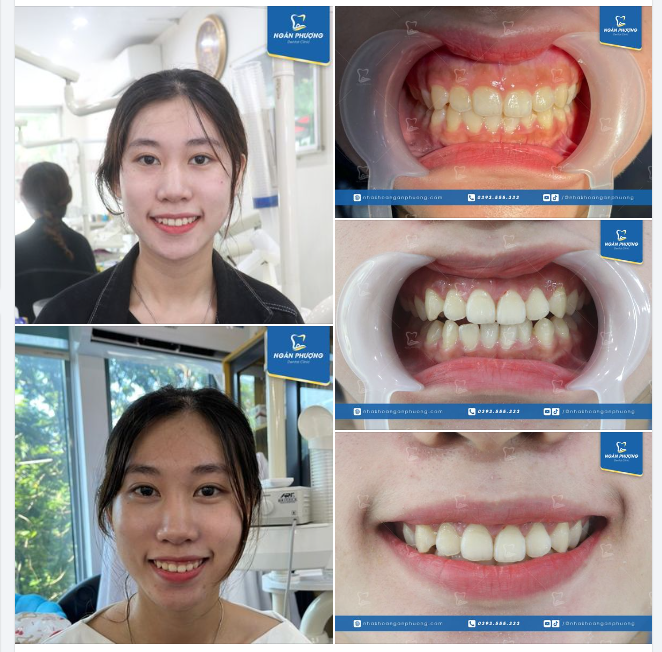 45 phút "xạc cả lốt" với nụ cười mới đầy tươi tắn