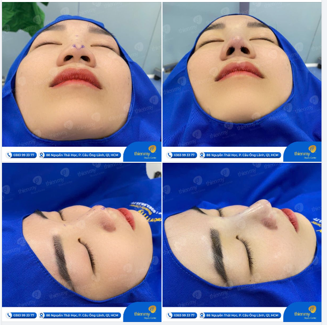 Sở hữu ngay dáng mũi cao thanh tú - Bí quyết tỏa sáng tự nhiên mà mọi cô gái đều mơ ước!