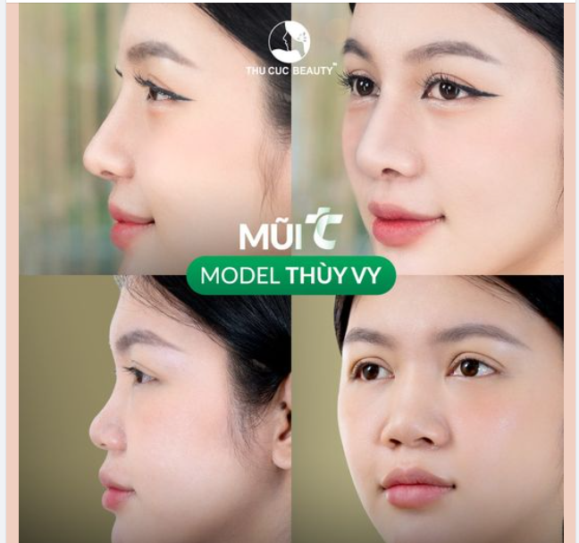 Đừng để chiếc mũi tẹt khiến bạn bị "phong ấn"  Chọn ngay Mũi TC