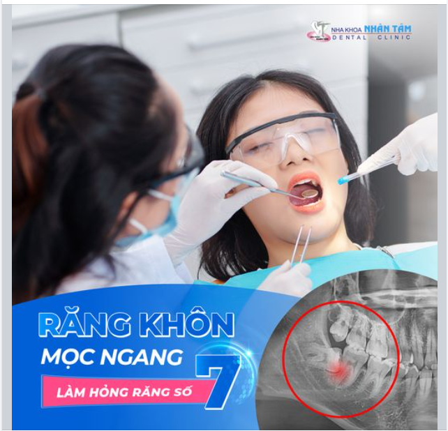 Răng khôn mọc ngang làm hỏng răng số 7
