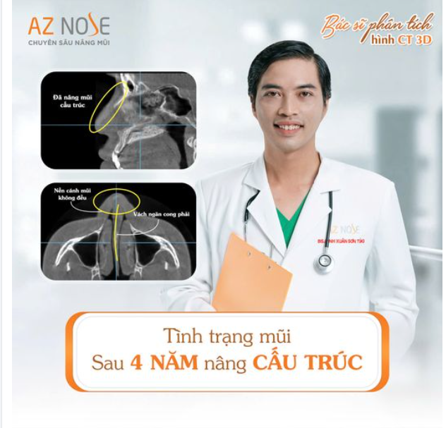 Có thể thấy gì bên trong dáng mũi đã nâng nhân tạo 4 năm?