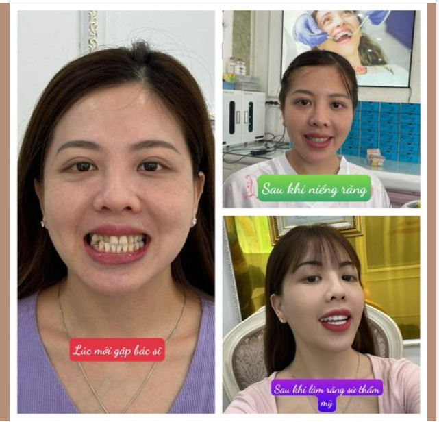 Răng mọc chen chúc phải làm thế nào?