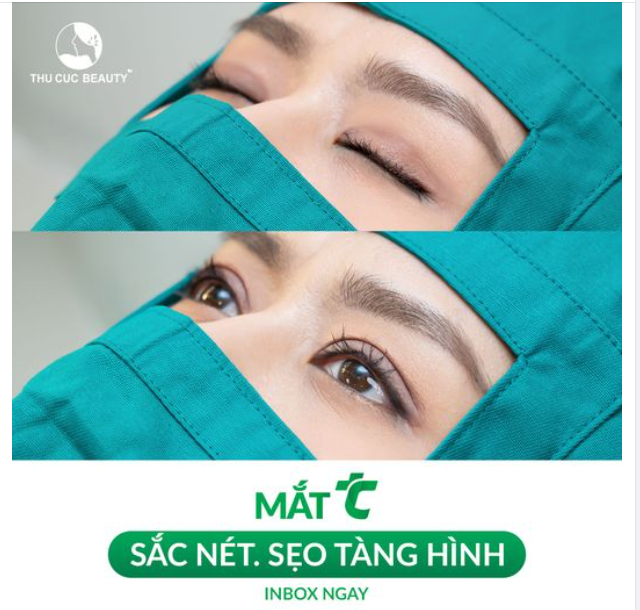 15P chia tay mí mắt không đều, đón nếp mí mới chuẩn từng li