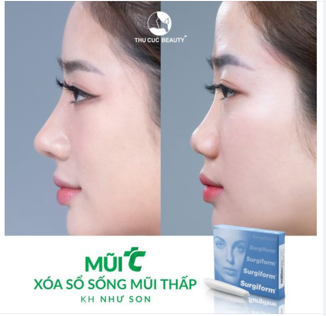 Nâng mũi Sụn Surgiform - Sụn mũi cao cấp được nhiều KH lựa chọn