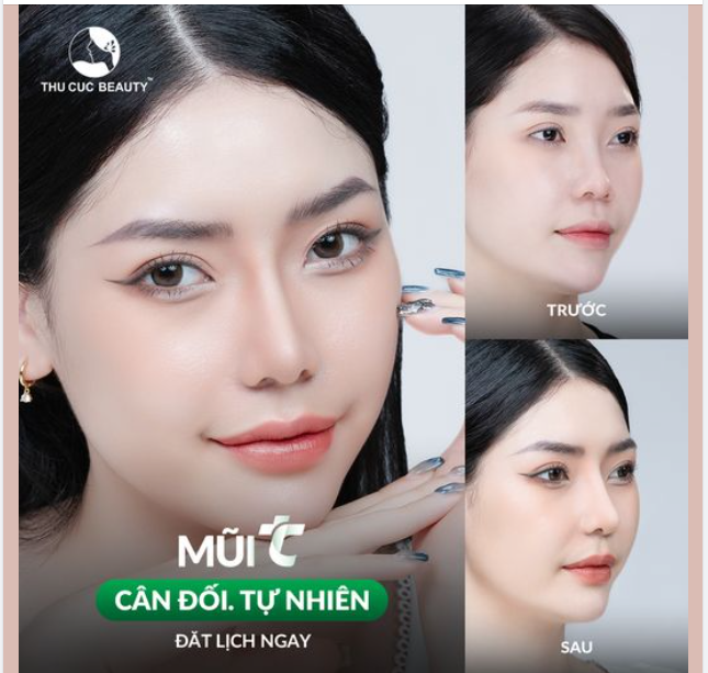 ĐẾn TC để Hô biến sống mũi thấp, đầu mũi to trở nên hài hòa, thanh thoát
