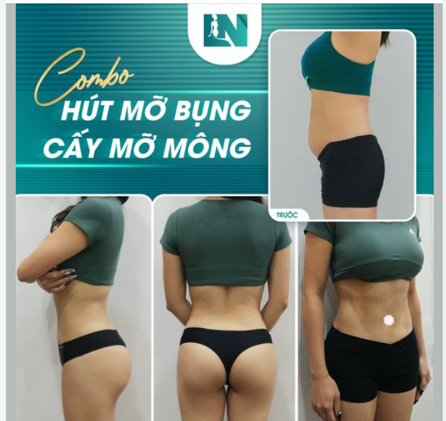 Flex nhẹ hình ảnh kết quả sau khi thực hiện combo hút mỡ bụng + cấy mỡ mông của khách mình nè.
