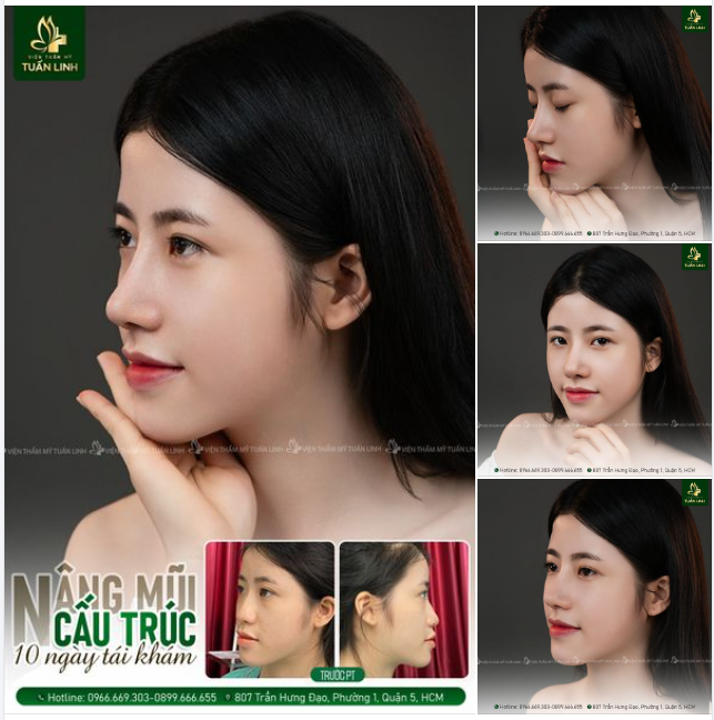 Mũi cấu trúc sau 10 ngày tái khám tại Tuấn Linh!!
