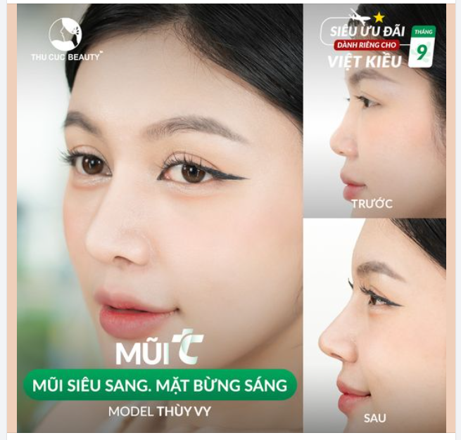 Nâng mũi siêu sang
