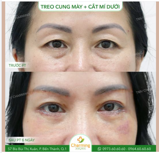 Trước khi phẫu thuật, nàng khách gặp phải tình trạng cung mày quá cao, làm cho gương mặt trông già dặn hơn so với tuổi.