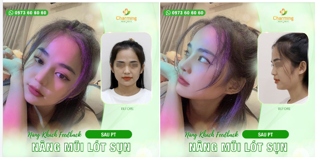 Nét duyên nàng sẵn có rồi. Mũi nàng lót sụn lại bồi phần duyên