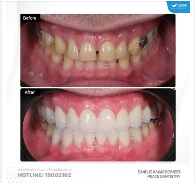 Ca lâm sàng thiết kế nụ cười cho khách hàng nam với mong muốn "nụ cười sáng, cuốn hút, đẹp tự nhiên và nam tính"
