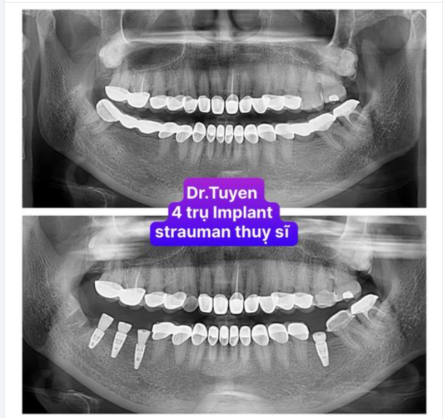 CHĂM SÓC RĂNG SAU KHI CẤY IMPLANT